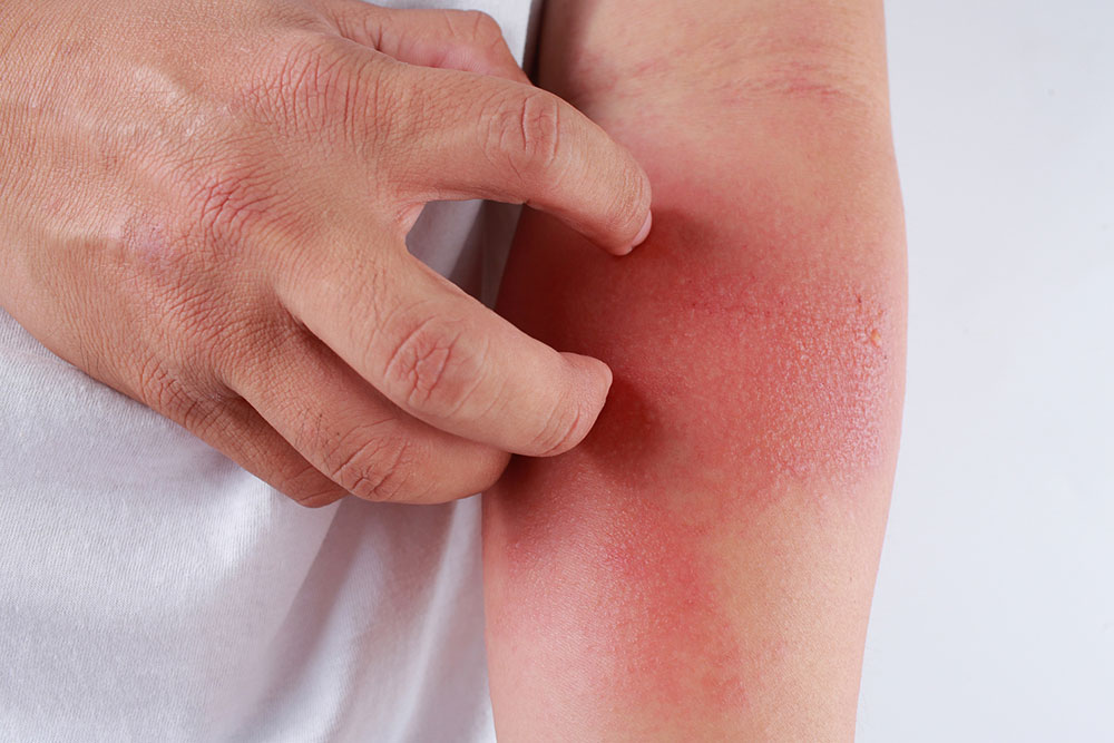 All You Need to Know about Eczema