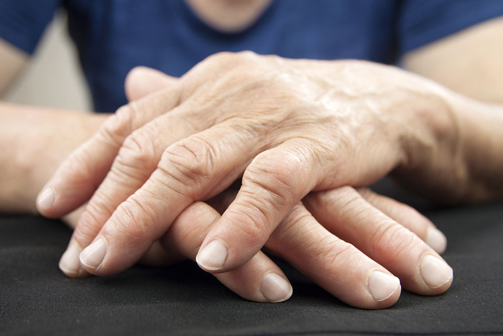 Rheumatoid Arthritis &#8211; Diagnosis and Treatment Options