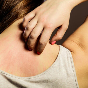 Tips to Treat Pain after Shingles