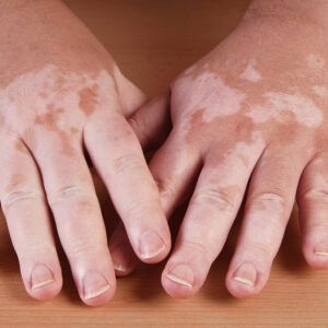 4 ways to prevent vitiligo from spreading