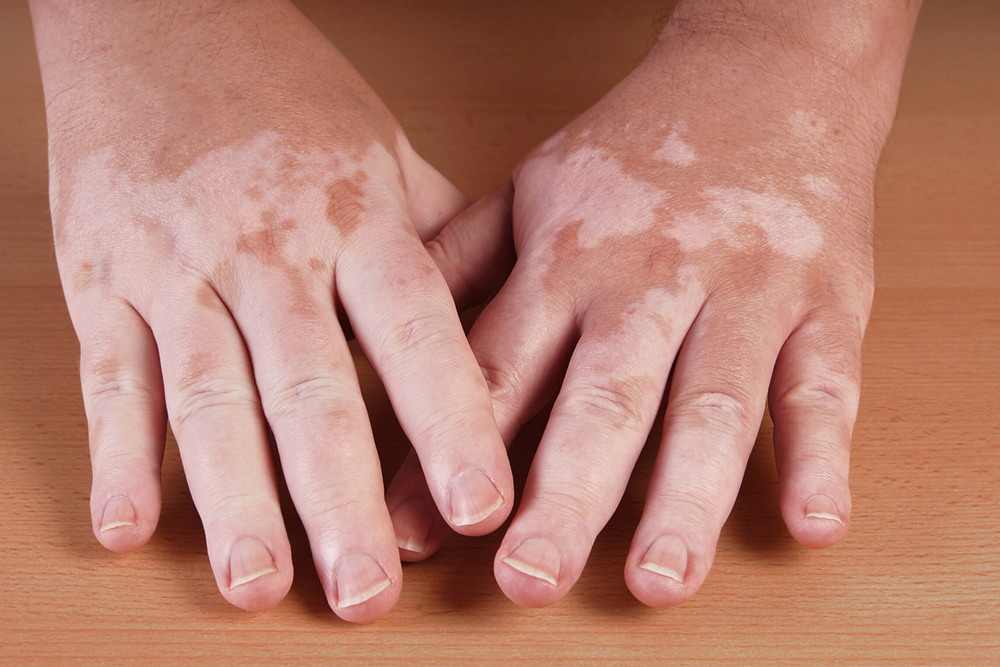 4 ways to prevent vitiligo from spreading